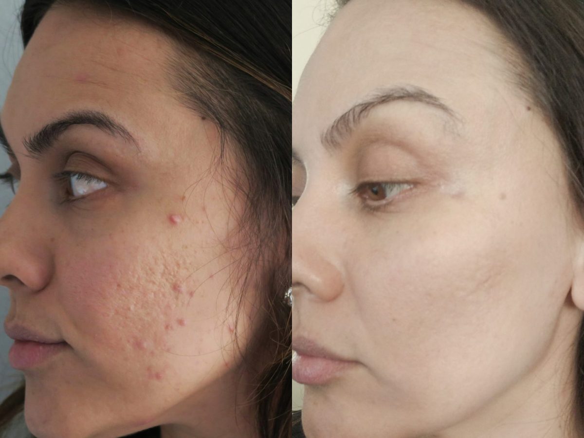 How I Got Rid Of My Acne Scars From Home